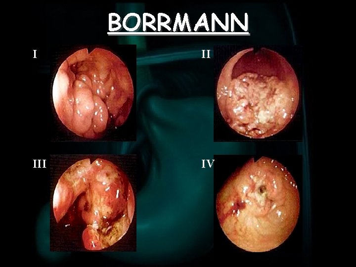 BORRMANN I II IV 