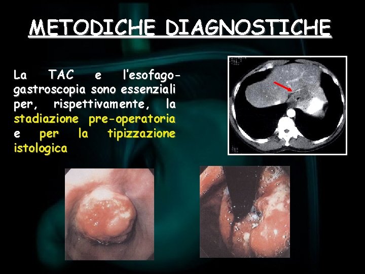 METODICHE DIAGNOSTICHE La TAC e l’esofagogastroscopia sono essenziali per, rispettivamente, la stadiazione pre-operatoria e