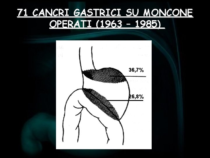 71 CANCRI GASTRICI SU MONCONE OPERATI (1963 – 1985) 36, 7% 26, 8% 