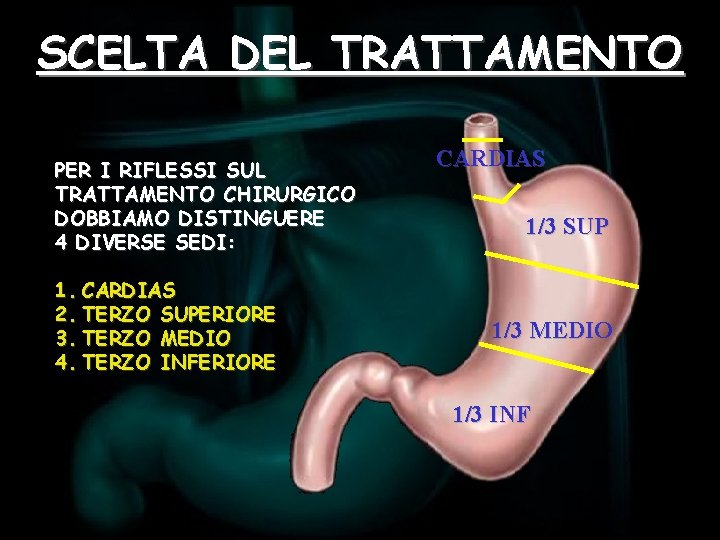 SCELTA DEL TRATTAMENTO PER I RIFLESSI SUL TRATTAMENTO CHIRURGICO DOBBIAMO DISTINGUERE 4 DIVERSE SEDI: