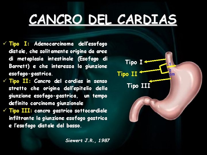 CANCRO DEL CARDIAS ü Tipo I: Adenocarcinoma dell’esofago distale, che solitamente origina da aree