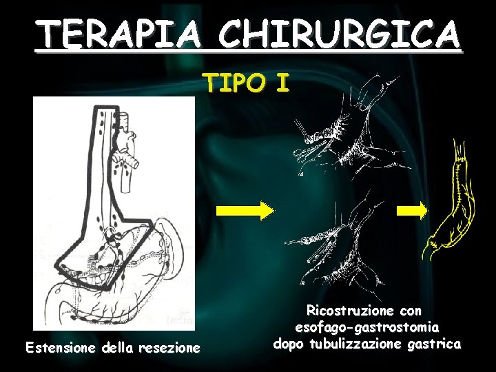 TERAPIA CHIRURGICA TIPO I Estensione della resezione Ricostruzione con esofago-gastrostomia dopo tubulizzazione gastrica 