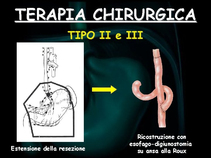 TERAPIA CHIRURGICA TIPO II e III Estensione della resezione Ricostruzione con esofago-digiunostomia su ansa