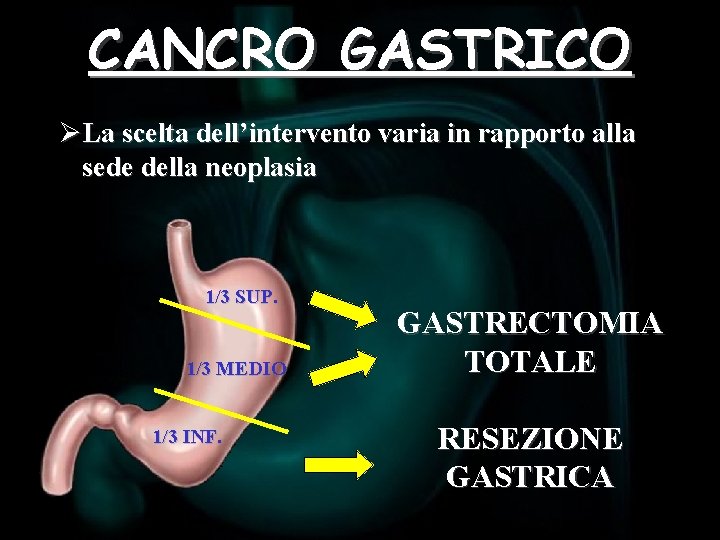 CANCRO GASTRICO ØLa scelta dell’intervento varia in rapporto alla sede della neoplasia 1/3 SUP.