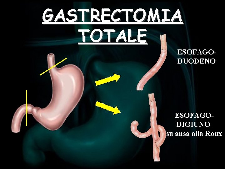 GASTRECTOMIA TOTALE ESOFAGODUODENO ESOFAGODIGIUNO su ansa alla Roux 