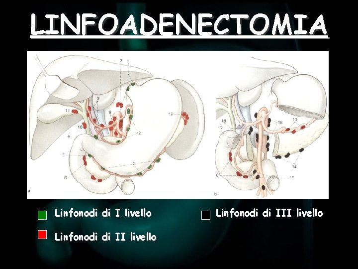 LINFOADENECTOMIA Linfonodi di I livello Linfonodi di III livello 