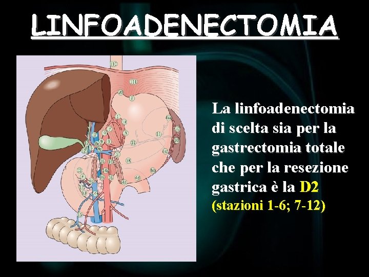 LINFOADENECTOMIA La linfoadenectomia di scelta sia per la gastrectomia totale che per la resezione