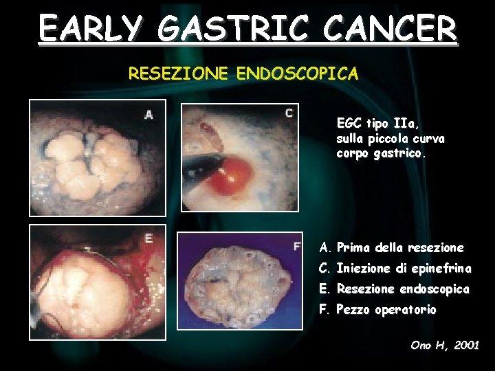EARLY GASTRIC CANCER RESEZIONE ENDOSCOPICA EGC tipo IIa, sulla piccola curva corpo gastrico. A.