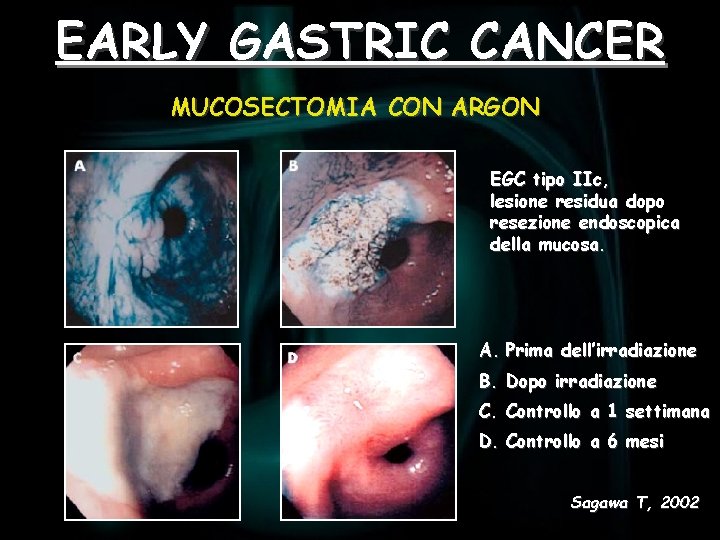 EARLY GASTRIC CANCER MUCOSECTOMIA CON ARGON EGC tipo IIc, lesione residua dopo resezione endoscopica