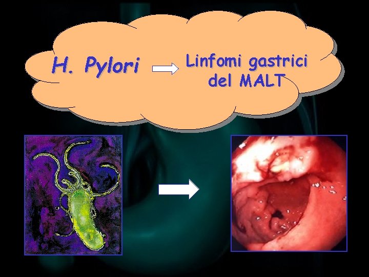 H. Pylori Linfomi gastrici del MALT 