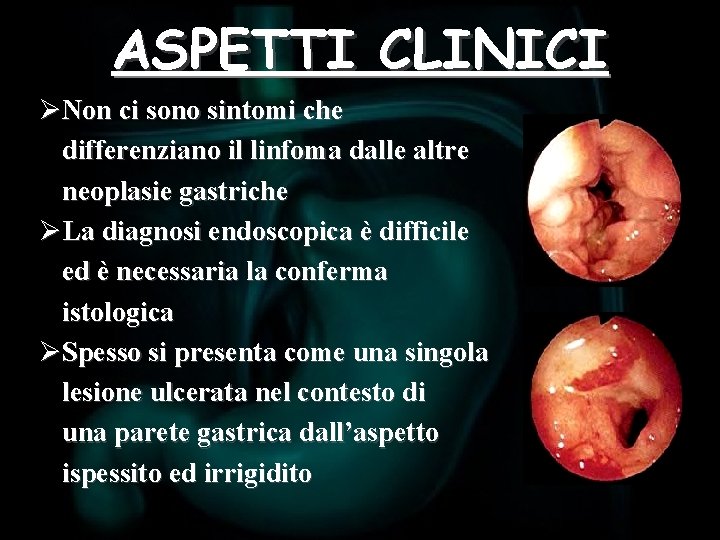 ASPETTI CLINICI ØNon ci sono sintomi che differenziano il linfoma dalle altre neoplasie gastriche