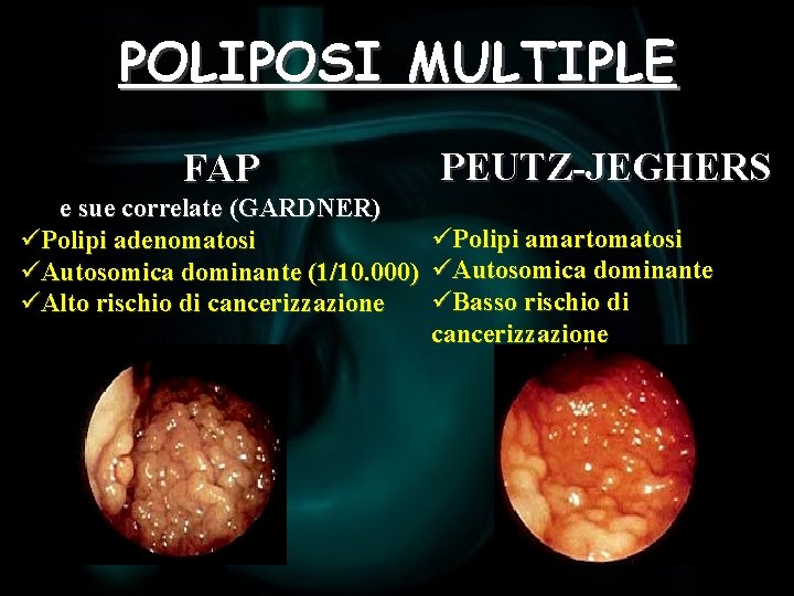 POLIPOSI MULTIPLE FAP e sue correlate (GARDNER) üPolipi adenomatosi üAutosomica dominante (1/10. 000) üAlto
