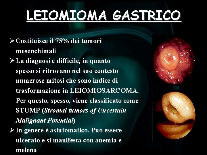 LEIOMIOMA GASTRICO Ø Costituisce il 75% dei tumori mesenchimali Ø La diagnosi è difficile,