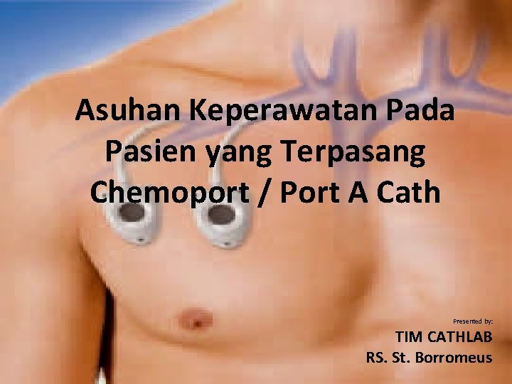 Asuhan Keperawatan Pada Pasien yang Terpasang Chemoport / Port A Cath Presented by: TIM