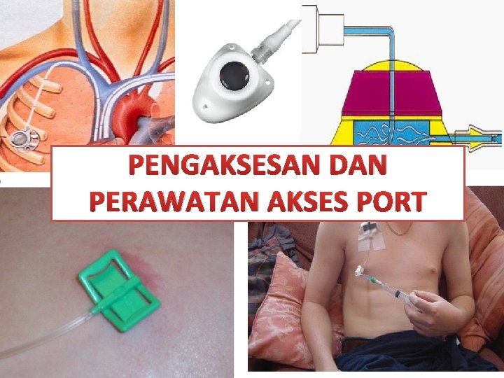 PENGAKSESAN DAN PERAWATAN AKSES PORT 