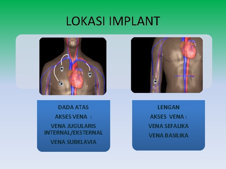 LOKASI IMPLANT DADA ATAS LENGAN AKSES VENA : VENA JUGULARIS INTERNAL/EKSTERNAL VENA SUBKLAVIA AKSES