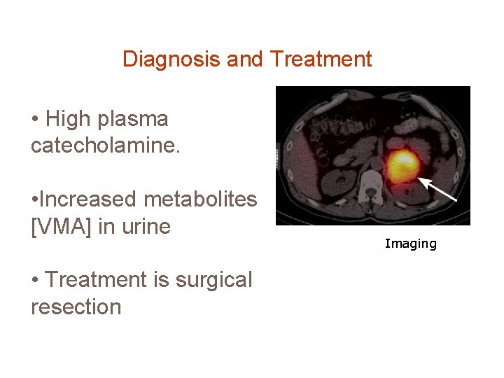 Diagnosis and Treatment • High plasma catecholamine. • Increased metabolites [VMA] in urine •