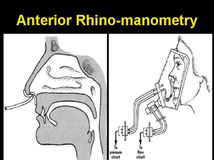 Anterior Rhino-manometry 