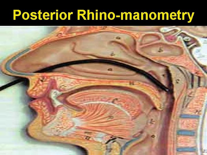 Posterior Rhino-manometry 