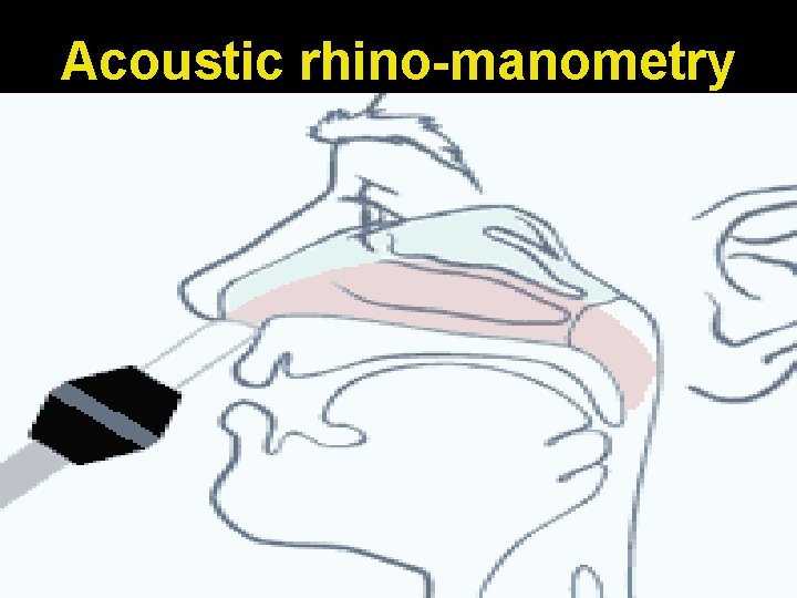 Acoustic rhino-manometry 