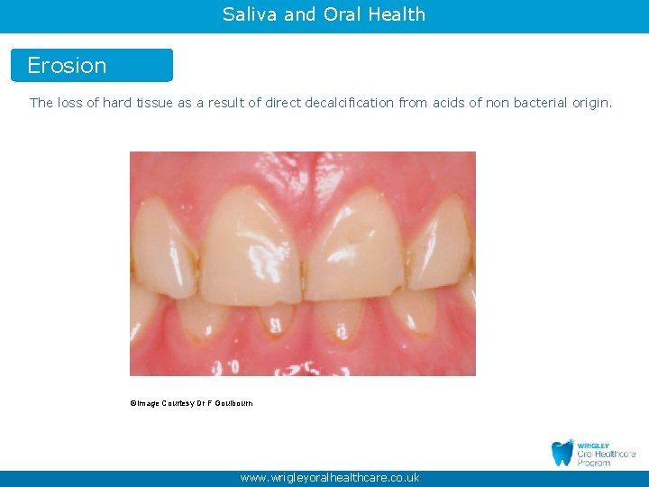 Saliva and Oral Health Erosion The loss of hard tissue as a result of