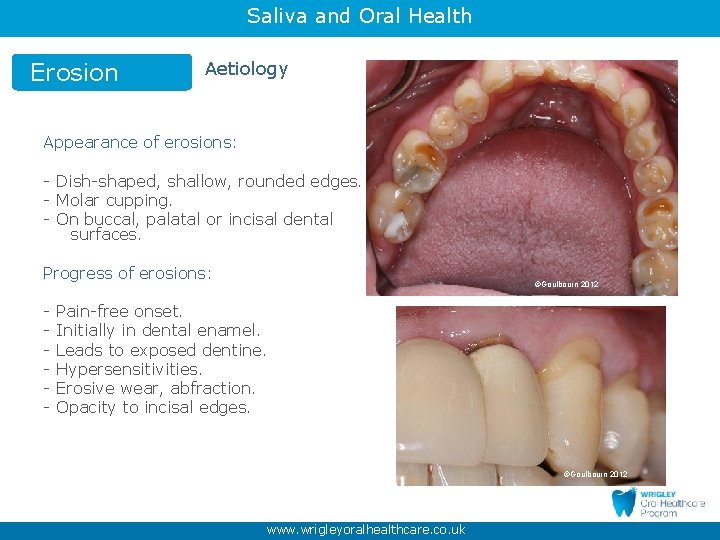 Saliva and Oral Health Erosion Aetiology Appearance of erosions: - Dish-shaped, shallow, rounded edges.