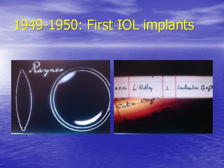 1949 -1950: First IOL implants 