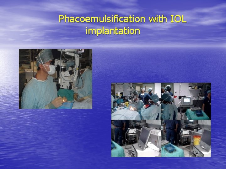 Phacoemulsification with IOL implantation 
