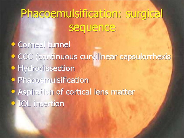 Phacoemulsification: surgical sequence • Corneal tunnel • CCC (continuous curvilinear capsulorrhexis • Hydrodissection •