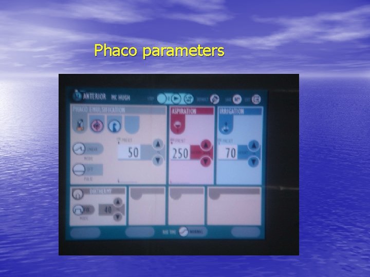 Phaco parameters 