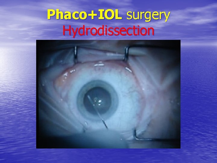 Phaco+IOL surgery Hydrodissection 