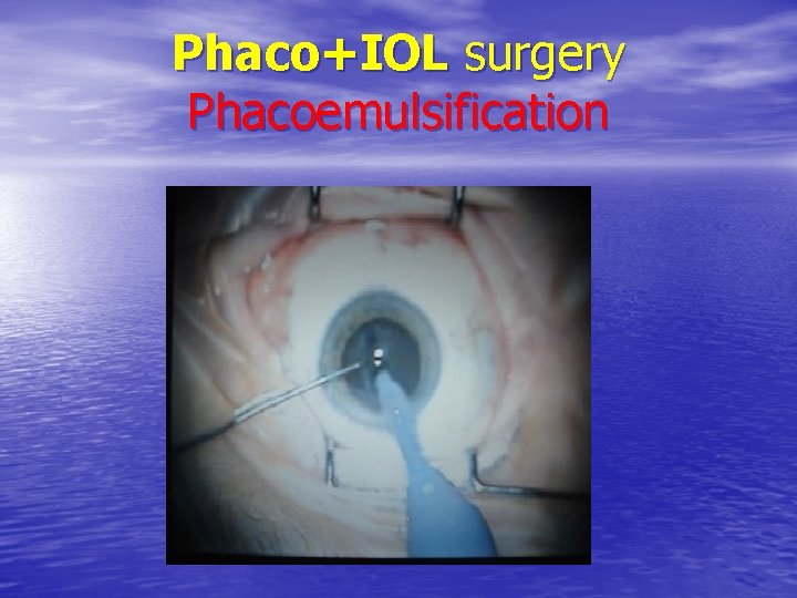Phaco+IOL surgery Phacoemulsification 