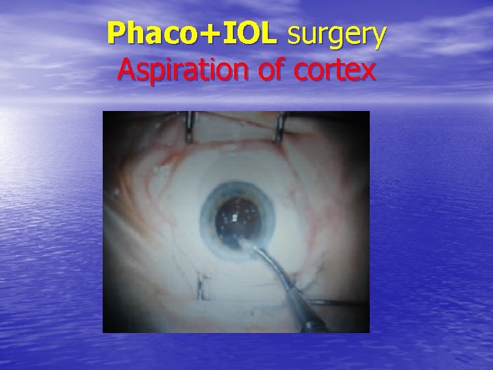 Phaco+IOL surgery Aspiration of cortex 