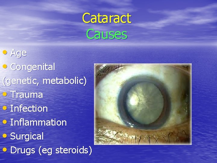 Cataract Causes • Age • Congenital (genetic, metabolic) • Trauma • Infection • Inflammation