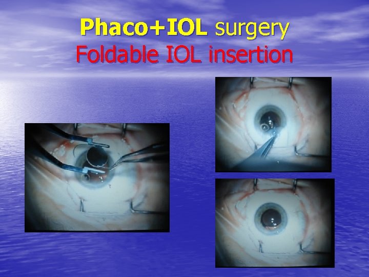 Phaco+IOL surgery Foldable IOL insertion 