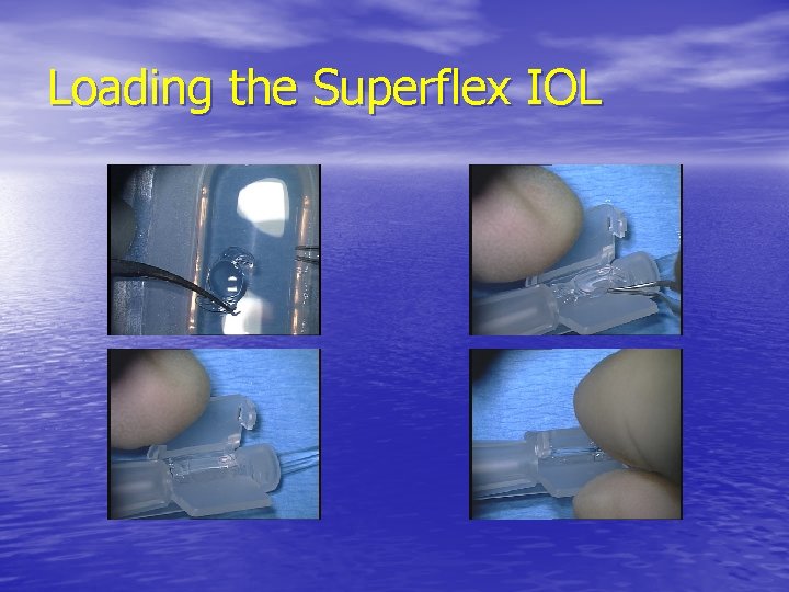 Loading the Superflex IOL 