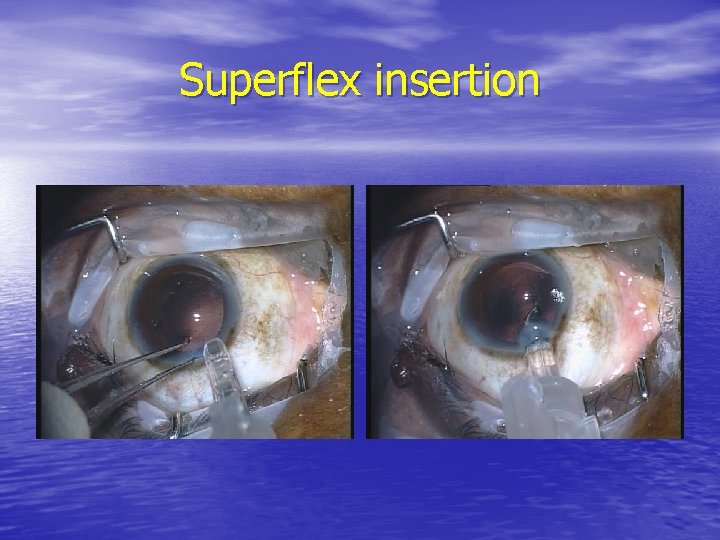 Superflex insertion 