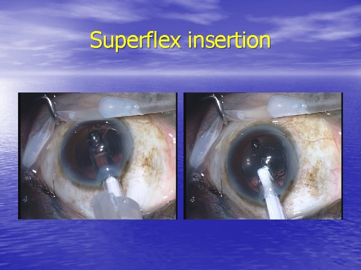 Superflex insertion 