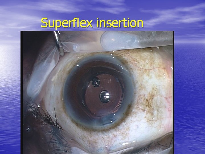 Superflex insertion 