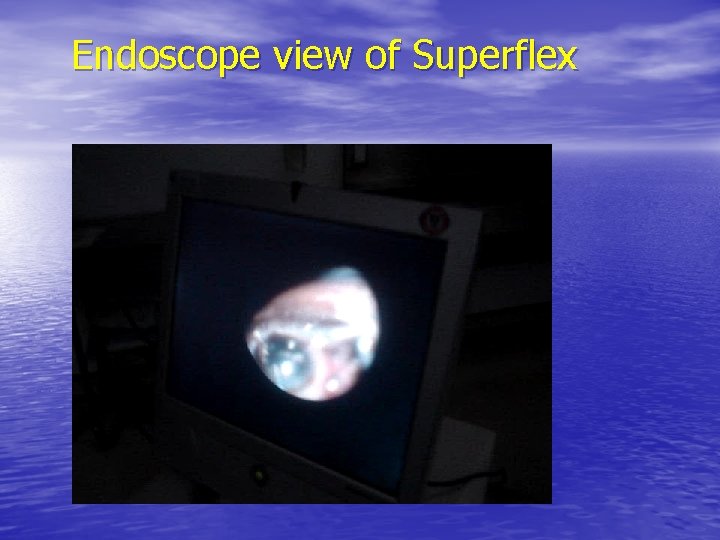 Endoscope view of Superflex 