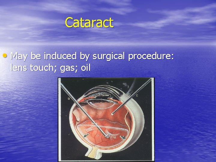 Cataract • May be induced by surgical procedure: lens touch; gas; oil 