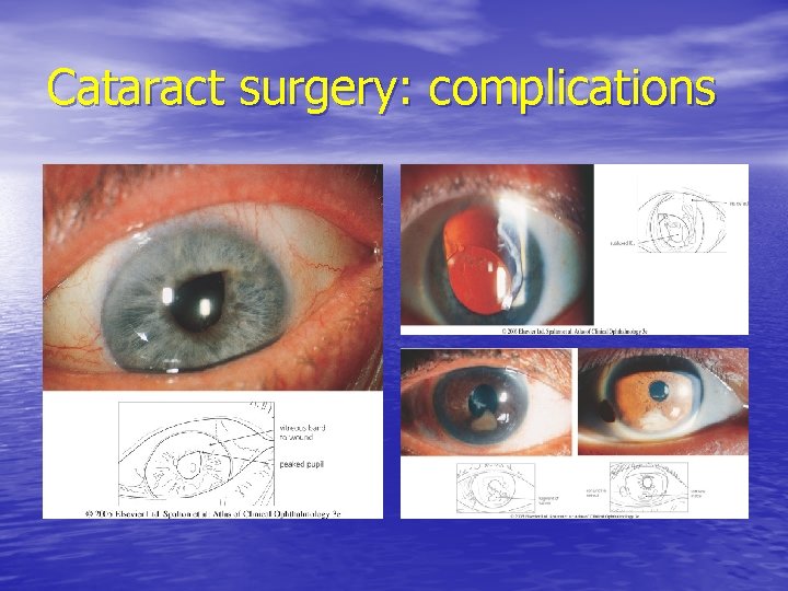 Cataract surgery: complications 