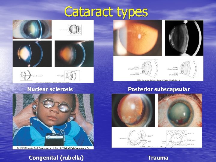 Cataract types Nuclear sclerosis Congenital (rubella) Posterior subscapsular Trauma 