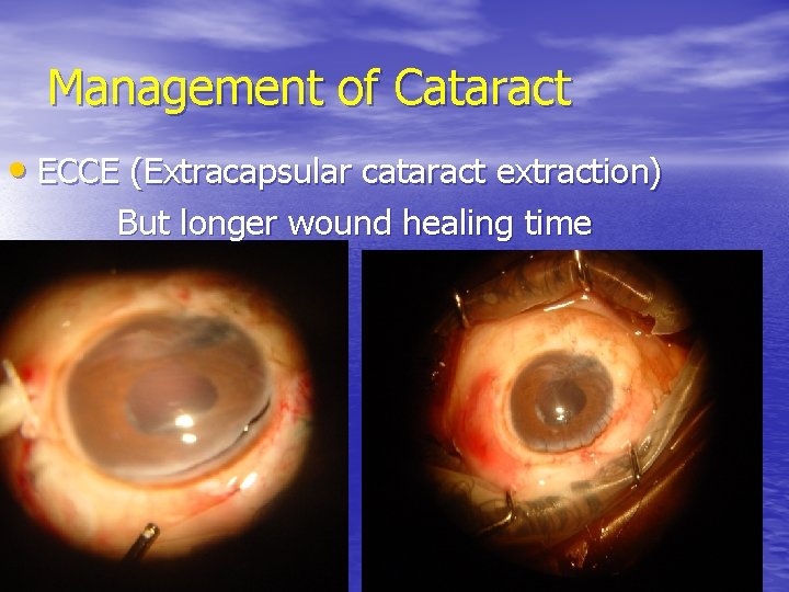 Management of Cataract • ECCE (Extracapsular cataract extraction) But longer wound healing time 