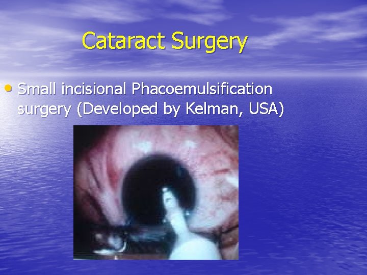 Cataract Surgery • Small incisional Phacoemulsification surgery (Developed by Kelman, USA) 