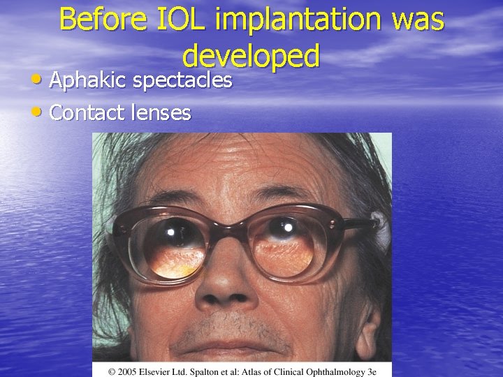 Before IOL implantation was developed • Aphakic spectacles • Contact lenses 