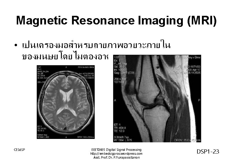 Magnetic Resonance Imaging (MRI) • เปนเครองมอสำหรบถายภาพอวยวะภายใน ของมนษยโดยไมตองอาศยการผาตด CESd. SP EEET 0485 Digital Signal Processing Magnetic Resonance Imaging (MRI) • เปนเครองมอสำหรบถายภาพอวยวะภายใน ของมนษยโดยไมตองอาศยการผาตด CESd. SP EEET 0485 Digital Signal Processing