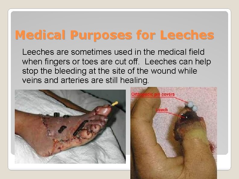 Medical Purposes for Leeches are sometimes used in the medical field when fingers or