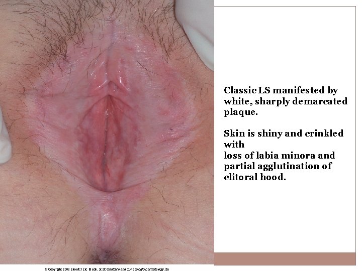 Classic LS manifested by white, sharply demarcated plaque. Skin is shiny and crinkled with