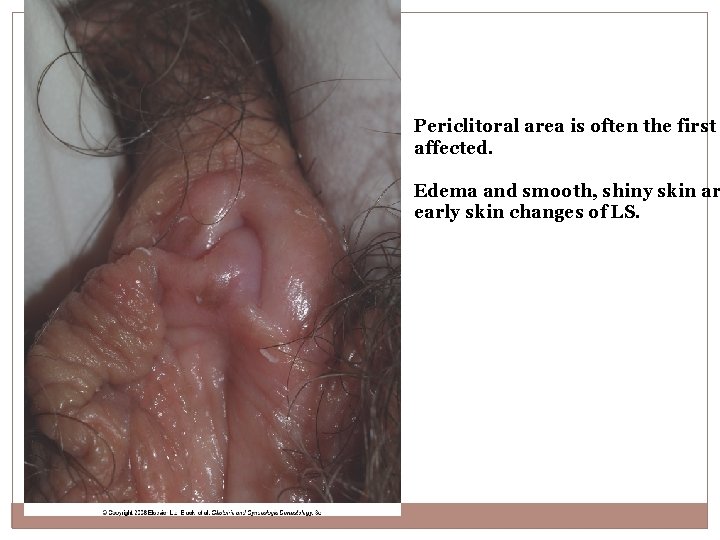 Periclitoral area is often the first affected. Edema and smooth, shiny skin ar early